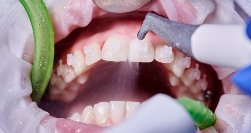 Professional teeth cleaning instruments