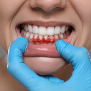 Bleeding Gums in Olathe, KS? Here’s What It Means