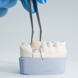 Same-Day Crowns in Olathe: How CEREC Works and Why It Beats the 2-Visit Method