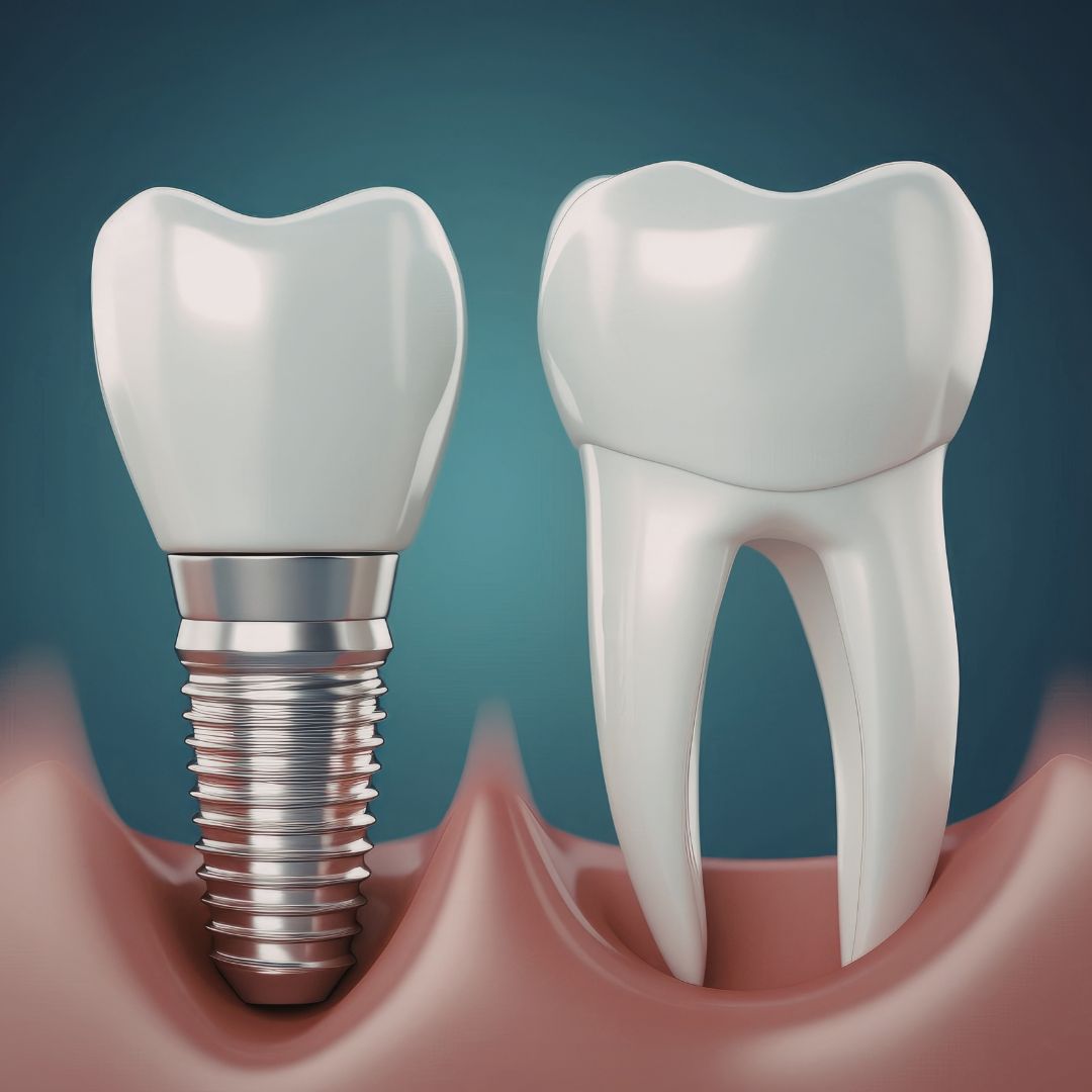 Dental Implants vs. Dentures vs. Bridges: Which Is Right for You?