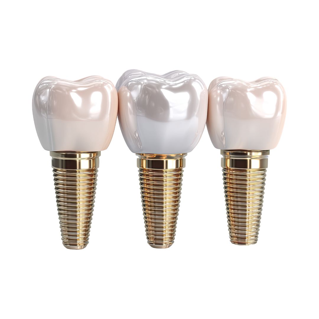 How Much Do Dental Implants Cost in Olathe, KS?
